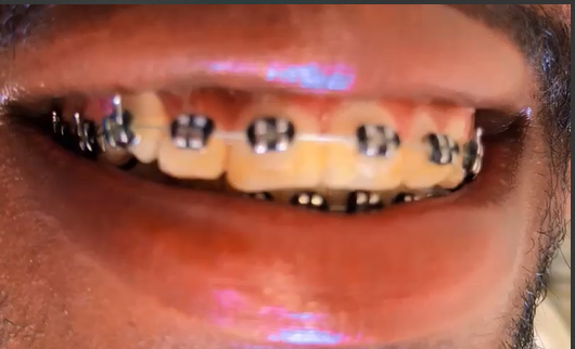 Braces Treatment in Nakuru